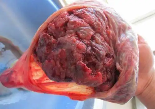 生完孩子胎盘该怎么处理?