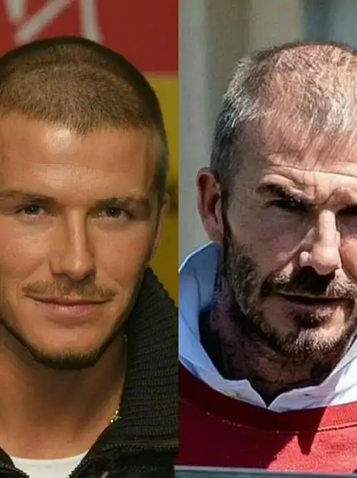 看到最近狗仔队发出的"小贝"近照,昔日的万人迷也难逃"秃头"命运,从前