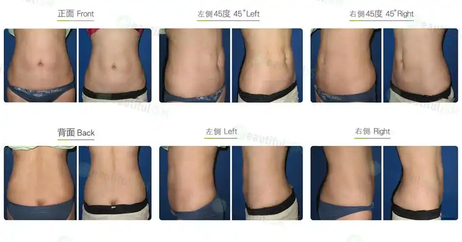 腰腹吸脂-后腰(女)效果图,案例前后对比照片