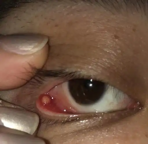 这两天觉得下眼皮小刺痛感,刚刚翻开来看长了颗痘,看着有白浓,这是