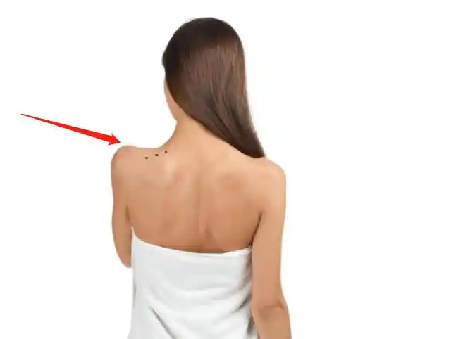 后背上这3种痣最有福,第1种健康长寿,第2种事业有成!