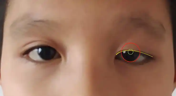 家长怎么发现孩子是否患有上睑下垂