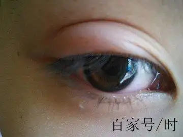 你是否有这种误区:眼浮肿就是肾病?看看还有哪些习惯导致眼浮肿