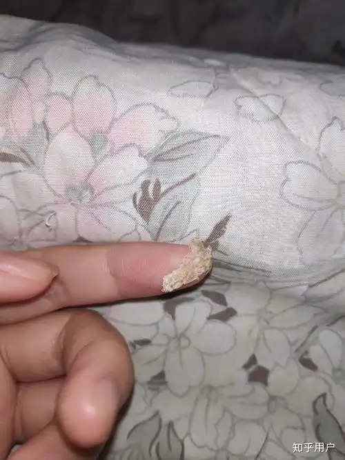 见过的最大头皮屑多大