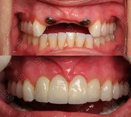 2021厦门种植牙价格表更新!