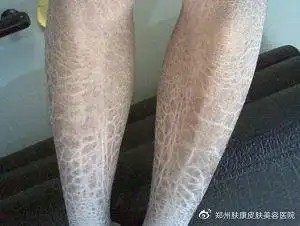 郑州肤康皮肤科为什么大雪天身上就起皮是鱼鳞病加重的信号