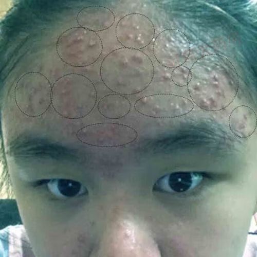 额头上长痘痘脸上长痘痘内分泌失调祛痘印痘坑粉刺闭口长痘祛痘膏祛痘