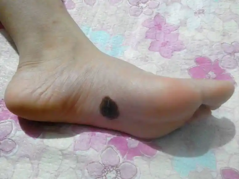 我是女孩,请问脚底长痣,出生像芝麻那么小,我长大它也大了,脚底长痣有