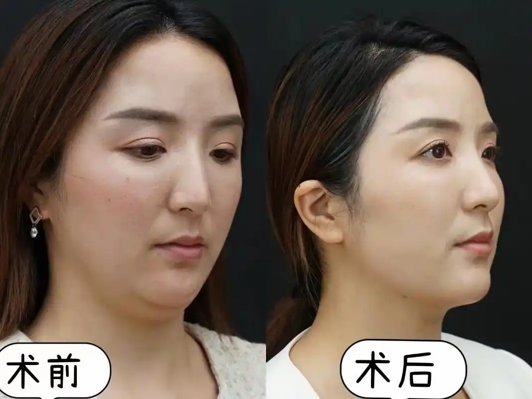 下颌少女线提升紧致效果合集