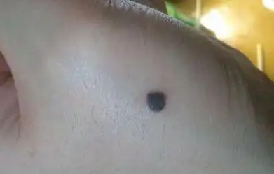 宝宝突发黑痣不是肿瘤照样要你命