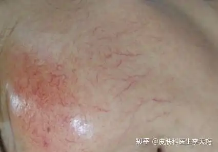 红血丝要怎么去除呢