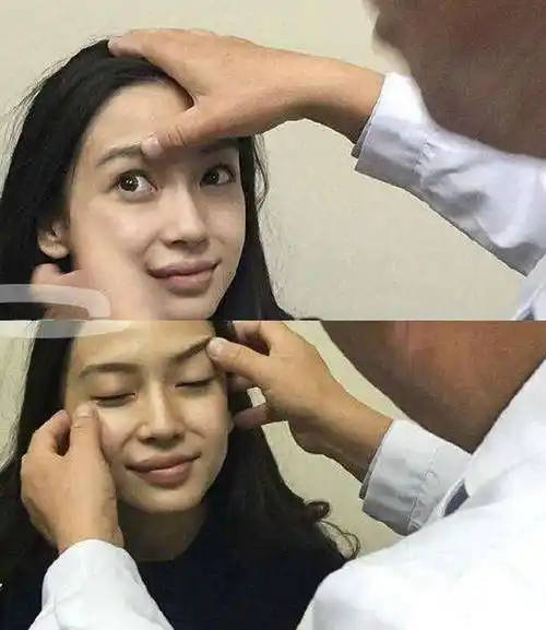 医生的回答是,杨颖的脸蛋没有动过,只矫正过牙齿.