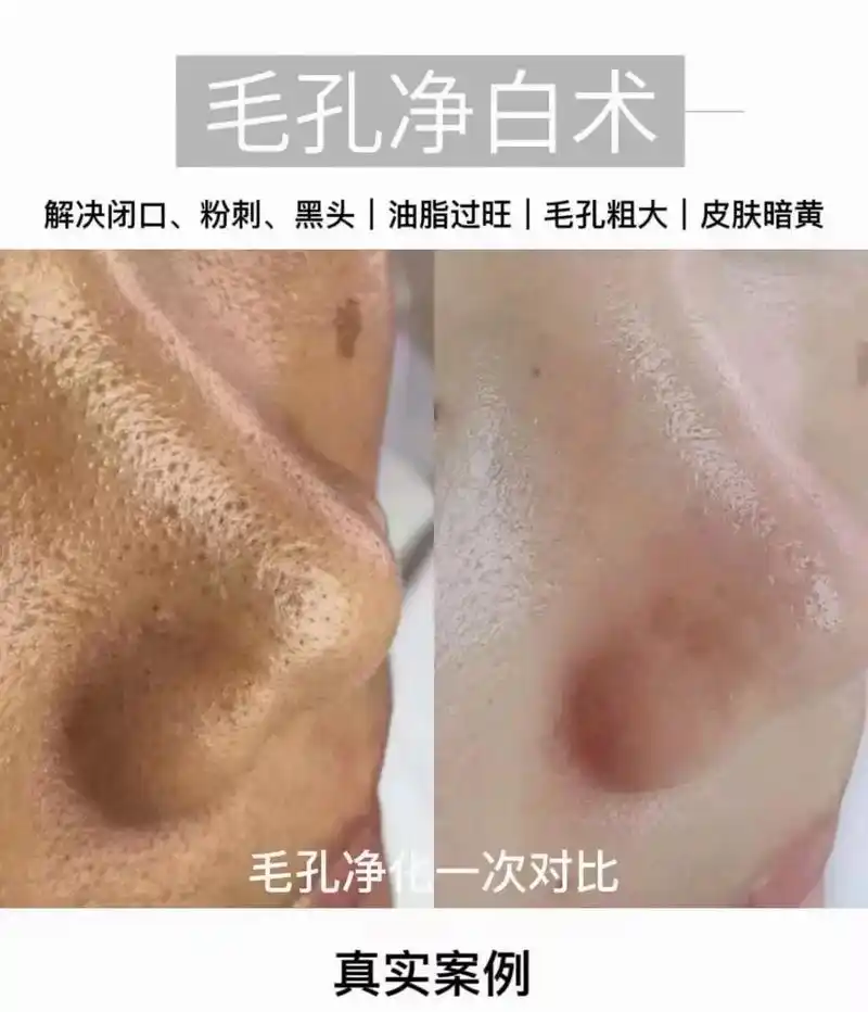 毛囊清洁术 ,选我们图片见证效果,#好东西一起分享给大家 - 抖音