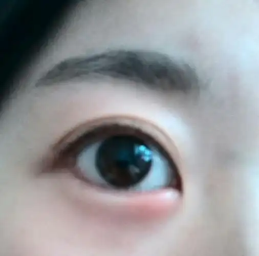 早上起来下眼皮很痛,然后发现下眼皮肿了