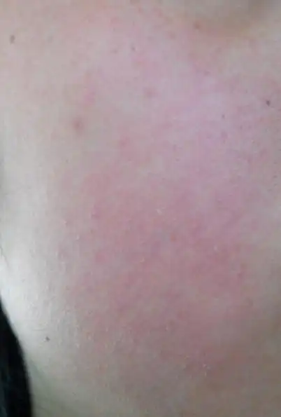 我星期五换的护肤品,星期六中午发现我的脸