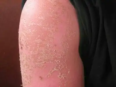 4楼 3  重度晒伤  重度晒伤是非常痛苦的,它的症状会有发红,发痒,发烫