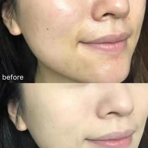 广州王女士使用前后对比