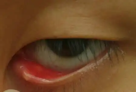下眼皮里面有个小洞 还有个脓的包 求解什么病