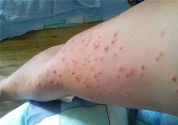 艾滋病初期症状皮疹多久会消失-精准抗艾-互联网艾滋病性病预防诊疗