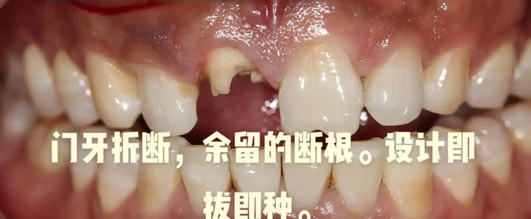 口腔健康 #爱护牙齿 #种植牙 #疫情早点结束  - 抖音