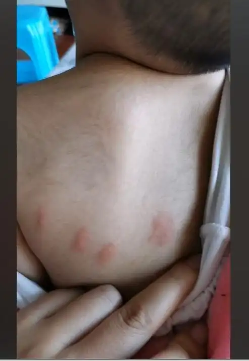 跳蚤咬的包是什么样的图片跳蚤咬的的疤痕多久能消