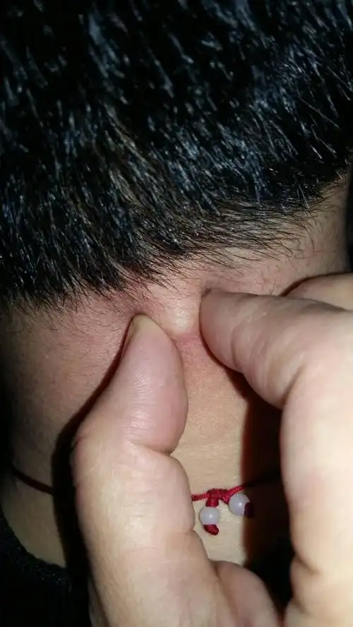 脖子后面原来长了一个粉刺,后来逐渐变硬了,也不疼不痒,就是摸着有