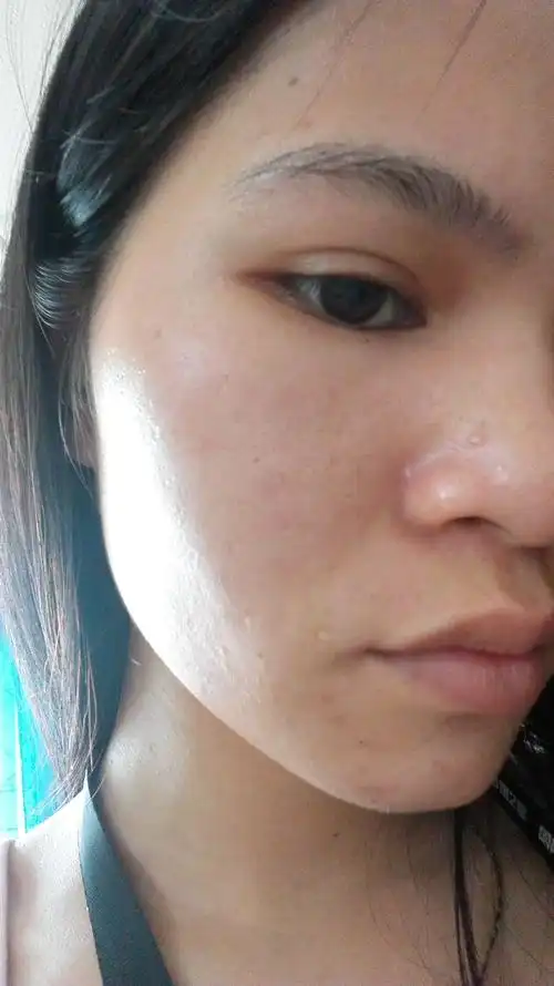 女,皮肤爱出油,暗黄,老是长痘痘,护肤品也在用,效果不明显,皮肤不好