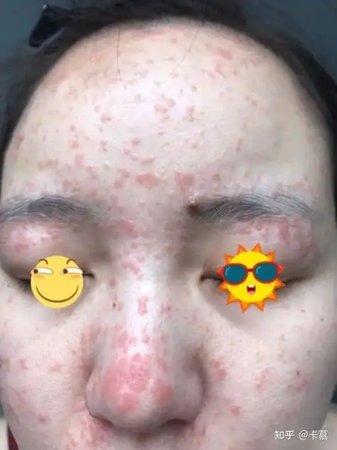 扁平疣长什么样子图片扁平疣的症状图片