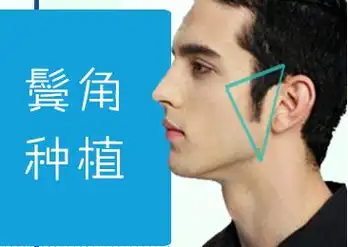 男生鬓角没有怎么办鬓角种植效果如何