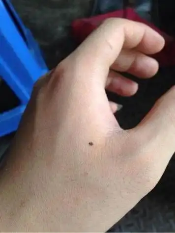 手背有痣高清图,手背有痣的命运图解