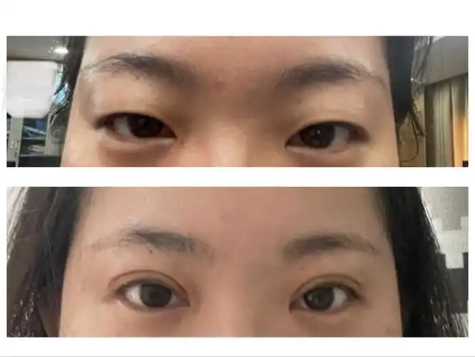 双眼皮术前术后对比