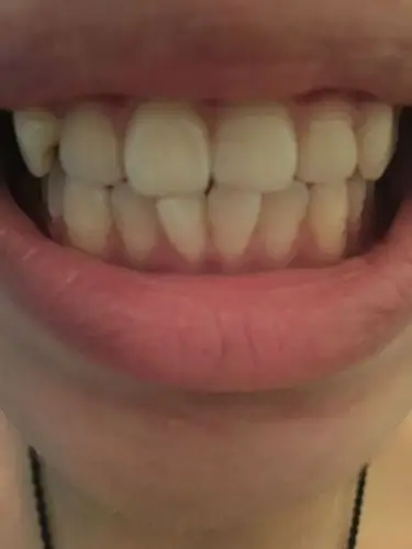 女, 快20岁, 嘴里右边上方这颗 虎牙,可以通过磨牙的方式磨平这颗虎牙