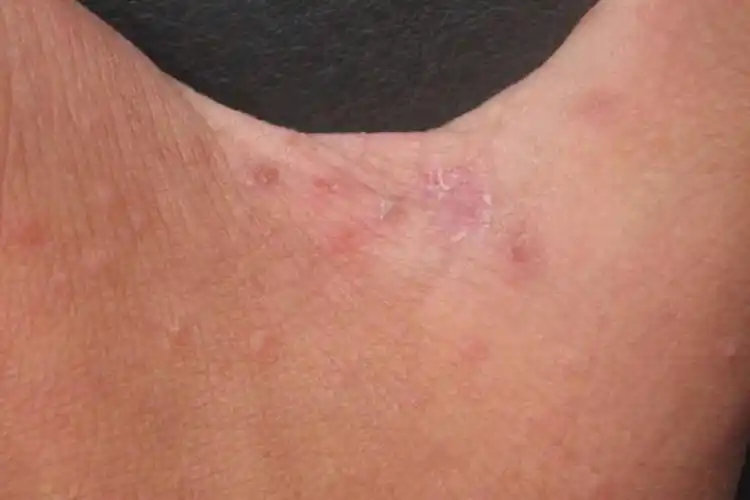 典型疥疮主要的表现是皮肤瘙痒,由于剧烈瘙痒,可在患者皮肤发现因搔抓