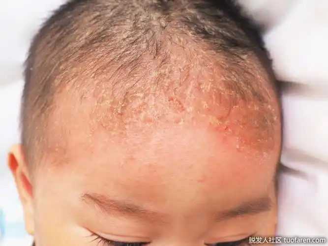 儿童脂溢性皮炎的图片1