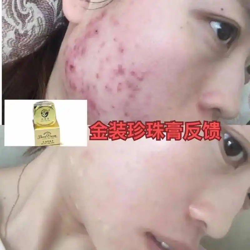 纯中药祛痘膏7815南澳深海珍珠膏7815.