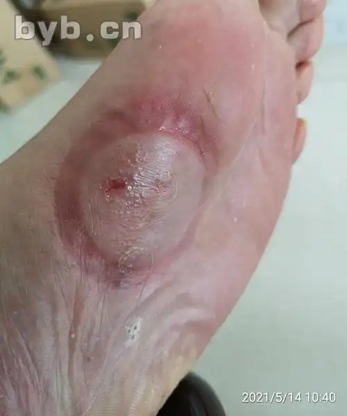 拔罐治脚气 一罐定乾坤