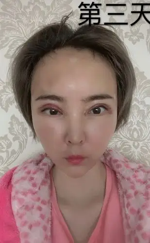 自体脂肪填充全脸第三天特别肿几天能消肿