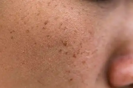 亚洲女人脸上的雀斑, 皮肤问题照片