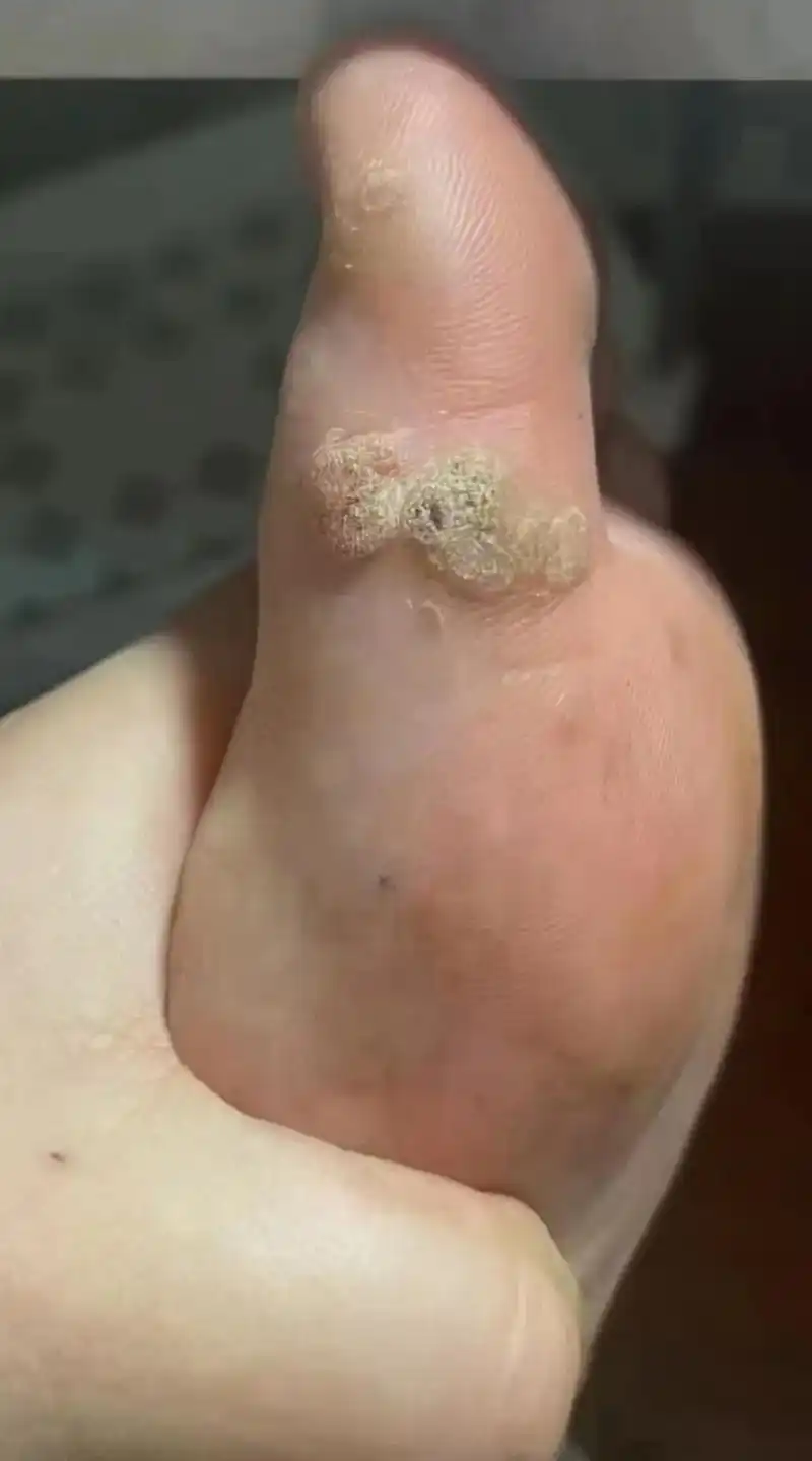 7815科普一下:不是鸡眼,不是鸡眼!