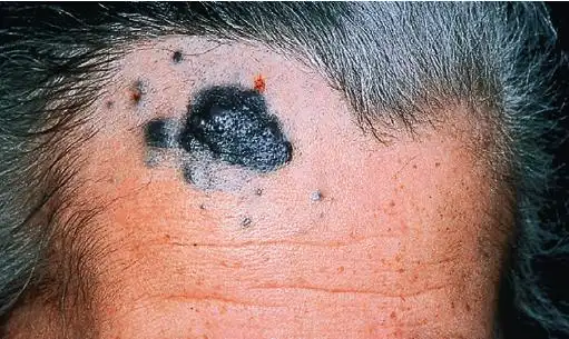 教您五字经,远离黑素瘤_黑色素瘤_疾病介绍_症状_介绍_症状表现 - 好