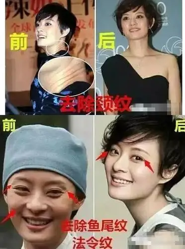 孙俪整容整哪了?孙俪海量蜕变照片(图)