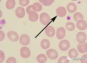 外周血细胞形态学室间质评合辑——红细胞