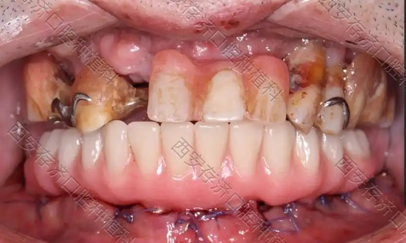 西安存济口腔医院口腔种植科舒适化下all-on-6下半口即刻种植固定修复