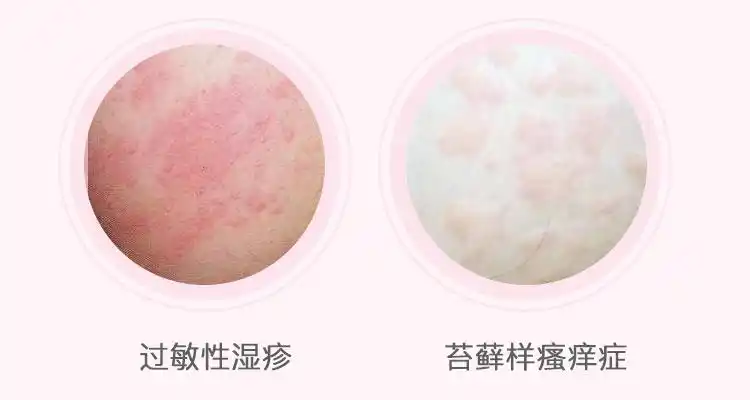 丁酸氢化可的松乳膏20g克涂抹成人儿童皮炎湿疹过敏性皮炎脂溢性皮炎