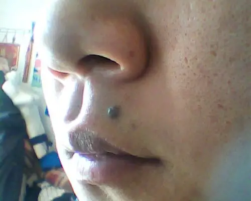 这个黑痣可以点掉吗