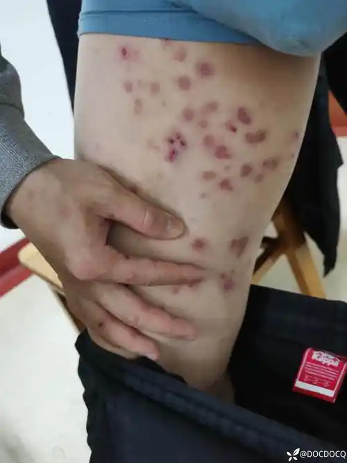 疱病多形红斑特应性皮炎