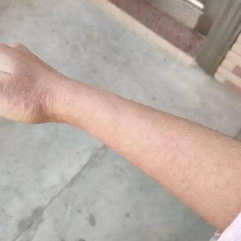 有人知道这是皮肤过敏还是怎么了前一段时间经常吃虾手臂