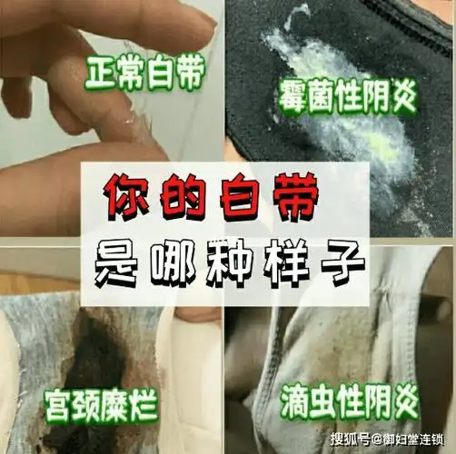 白带突然变得清澈如水,经常弄湿内裤,并伴有臭味?