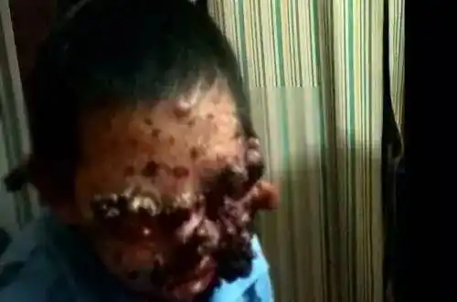 触目丨海原13岁美丽女孩患病变鬼脸,头部生蛆,父亲绝望放弃治疗,命悬