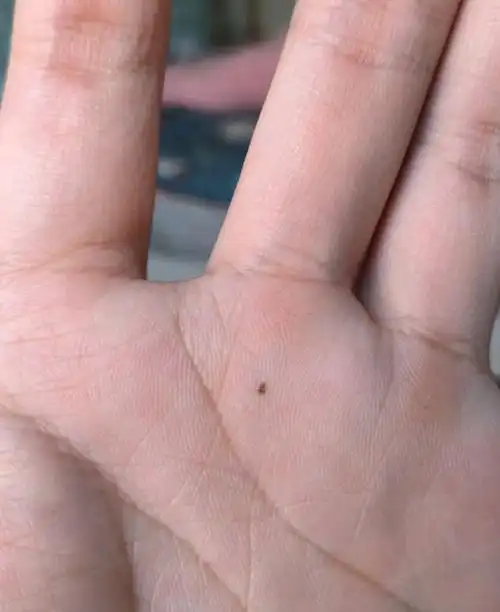 为什么我手掌心长了一颗痣,这是什么寓意?